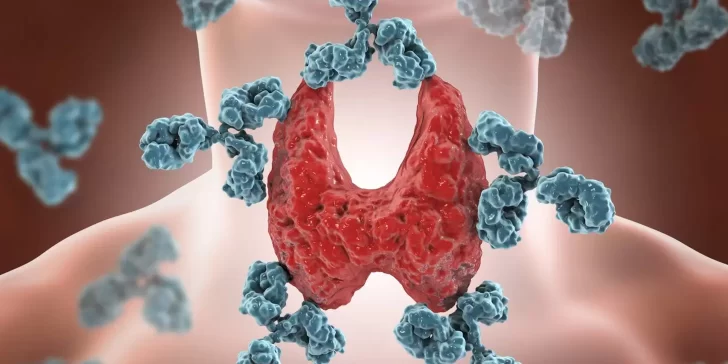 Tiroiditis de Hashimoto: Inmunopatía de la tiroides